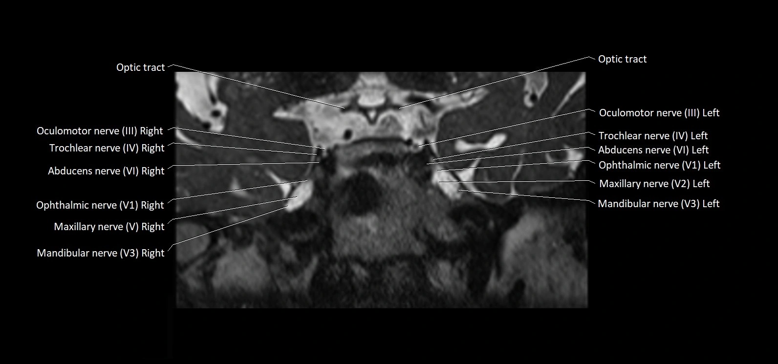 Cranial nerve cross sectional anatomy coronal 3T MRI image 31.webp